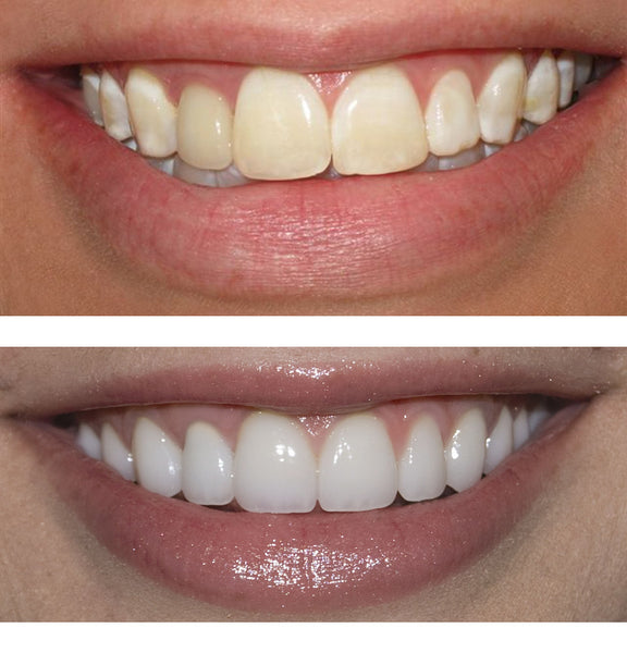 Buy One Get One Free Sparkle White Teeth Whitening Kit